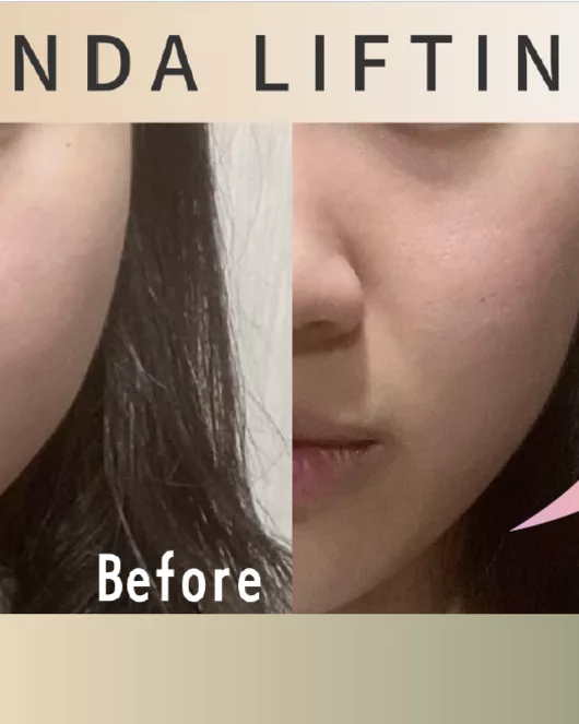 小脸紧致护理(Onda Lift+LDM)