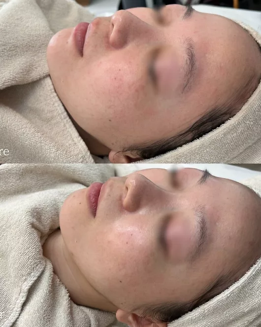 Skin Quality Improvement Course (Peeling + Plasma + LDM)